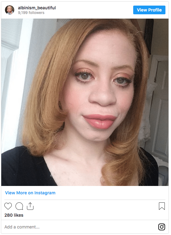 albinism hair color instagram post